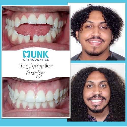 Transformation Tuesday - Munk Orthodontics Patient