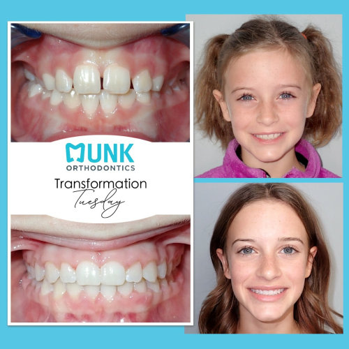 Transformation Tuesday - Munk Orthodontics Patient