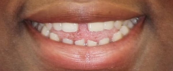 Patient 1 Before Invisalign Treatment.