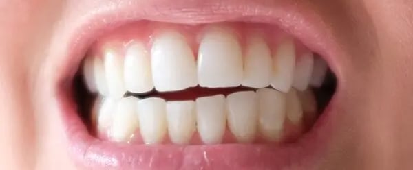 Patient 2 Before Invisalign Treatment.