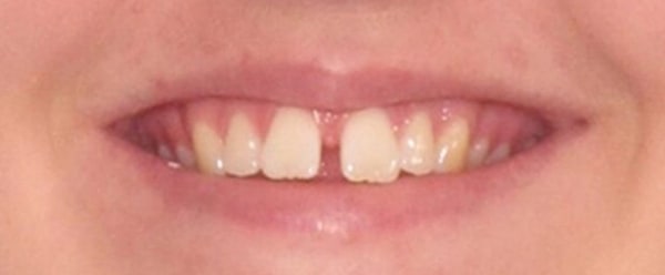 Patient 3 Before Invisalign Treatment.