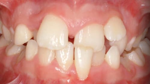 Before Treatment with Braces at Waldman Orthodontics