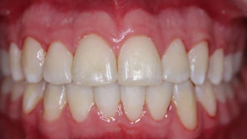 After Treatment with Braces at Waldman Orthodontics