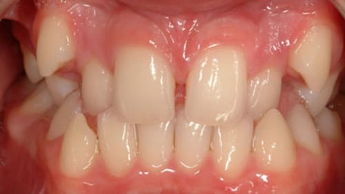 Before Treatment with Braces at Waldman Orthodontics