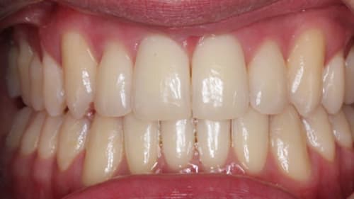 After Treatment with Braces at Waldman Orthodontics