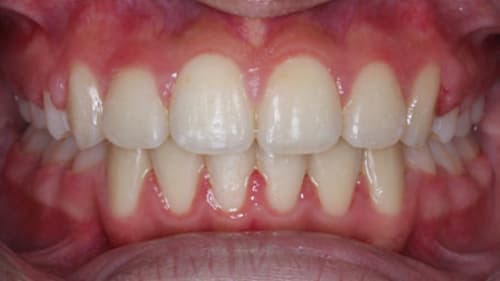 After Treatment with Braces at Waldman Orthodontics