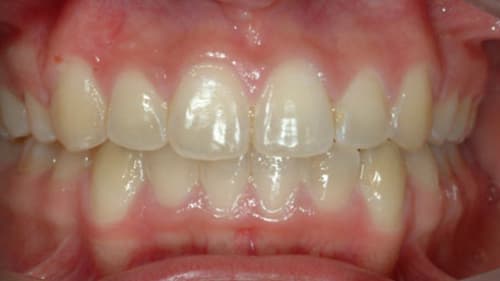 After Treatment with Braces at Waldman Orthodontics