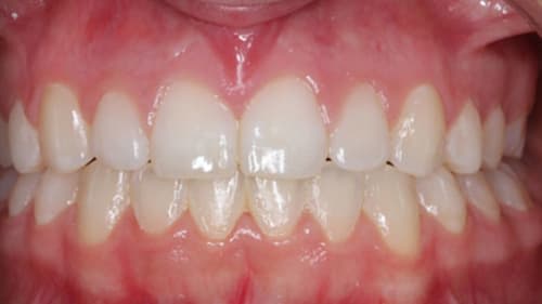 After Treatment with Braces at Waldman Orthodontics