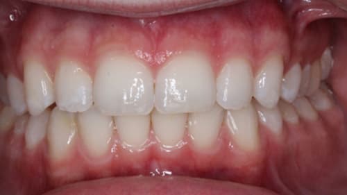 After Treatment with Braces at Waldman Orthodontics