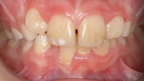 Before Treatment with Braces at Waldman Orthodontics
