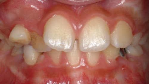 Before Treatment with Braces at Waldman Orthodontics