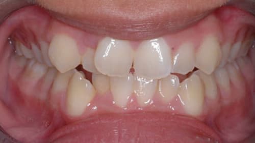 Before Treatment with Braces at Waldman Orthodontics