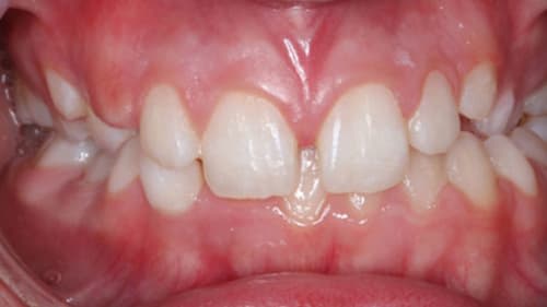 Before Treatment with Braces at Waldman Orthodontics