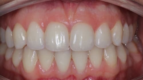 After Treatment with Braces at Waldman Orthodontics