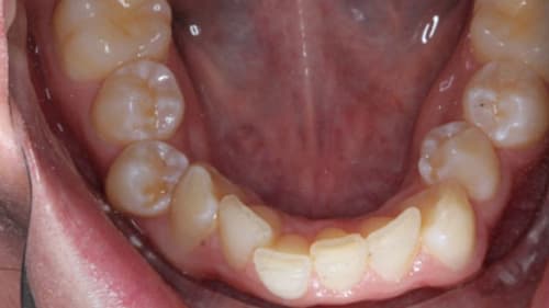 Before Treatment with Clear Aligners at Waldman Orthodontics