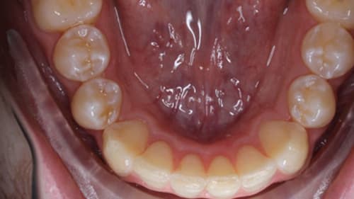 After Treatment with Clear Aligners at Waldman Orthodontics