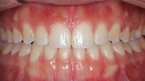After Treatment with Clear Aligners at Waldman Orthodontics