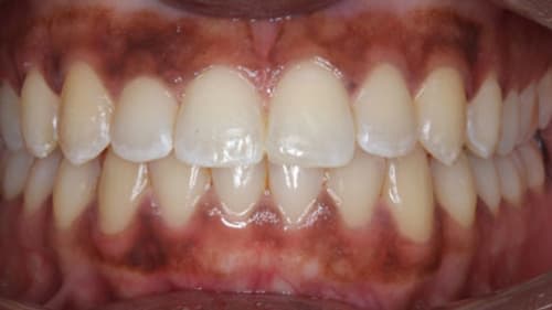 After Treatment with Clear Aligners at Waldman Orthodontics