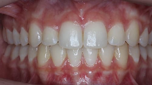 After Treatment with Clear Aligners at Waldman Orthodontics