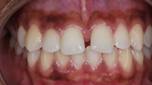 Before Treatment with Clear Aligners at Waldman Orthodontics