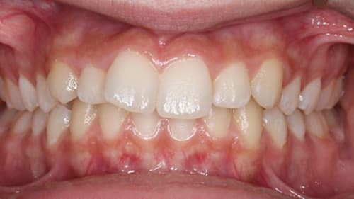 Before Treatment with Clear Aligners at Waldman Orthodontics