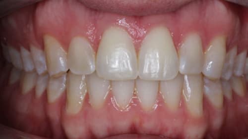 After Treatment with Clear Aligners at Waldman Orthodontics