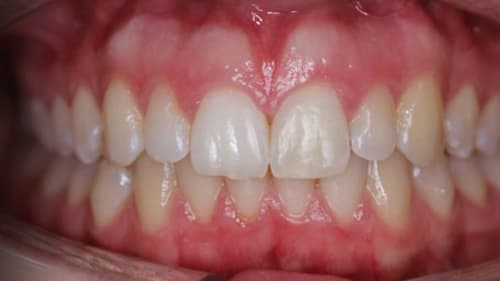 After Treatment with Clear Aligners at Waldman Orthodontics