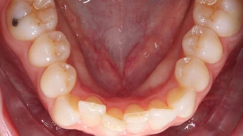 Before Treatment with Clear Aligners at Waldman Orthodontics