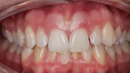 Before Treatment with Clear Aligners at Waldman Orthodontics