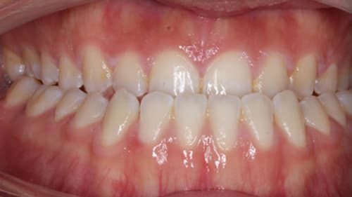 Before Treatment with Clear Aligners at Waldman Orthodontics