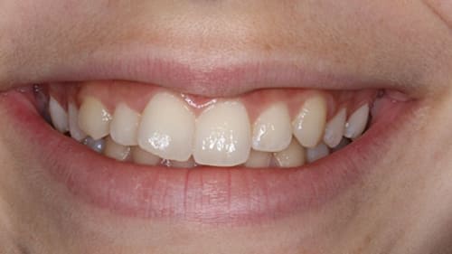 Before Treatment with Clear Aligners at Waldman Orthodontics