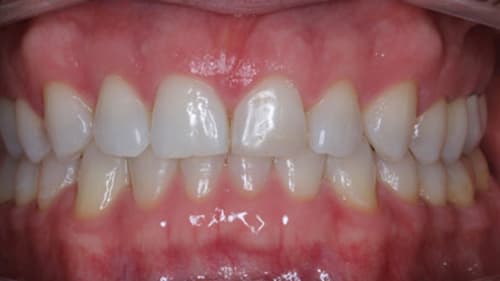 After Treatment with Clear Aligners at Waldman Orthodontics