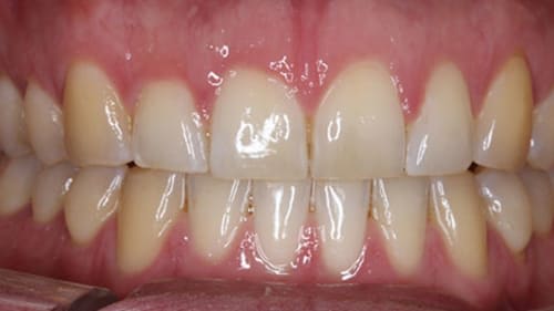After Treatment with Clear Aligners at Waldman Orthodontics