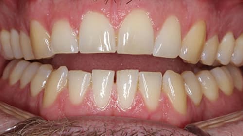 Before Treatment with Clear Aligners at Waldman Orthodontics