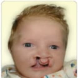 Bilateral Cleft Lip – Before	