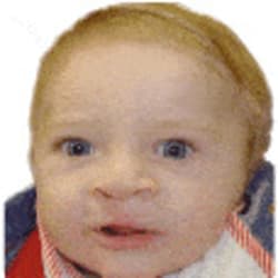 Bilateral Cleft Lip – After