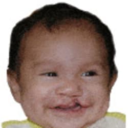  Unilateral Cleft Lip – Before	