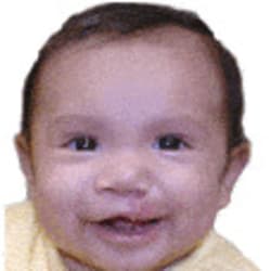  Unilateral Cleft Lip – After