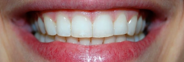 Invisalign