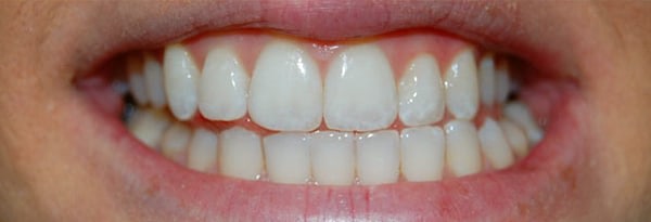 Invisalign