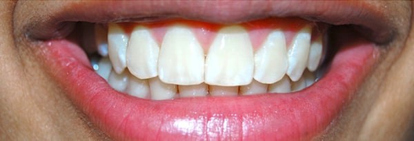 Invisalign