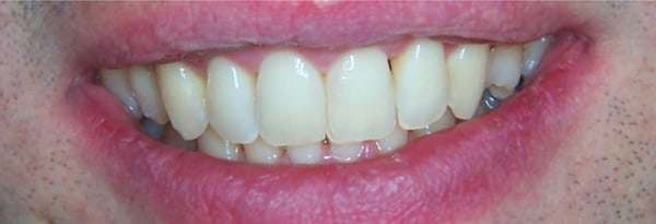 Invisalign