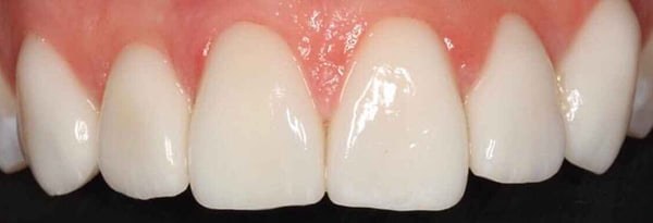 Veneers