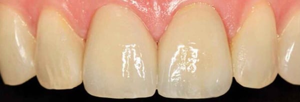 Veneers