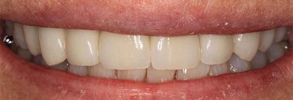 Veneers
