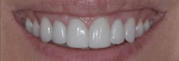 Dental Implants Before & After