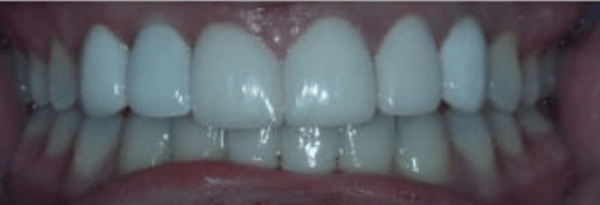 Dental Implants Before & After