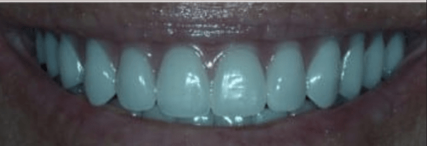 Dental Implants Before & After