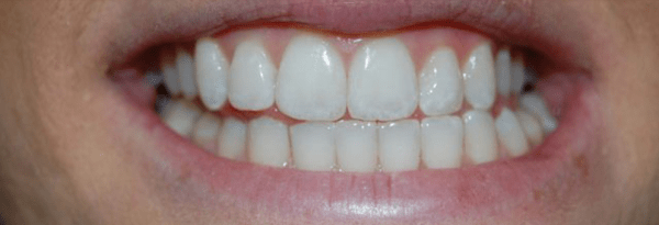Invisalign Before & After