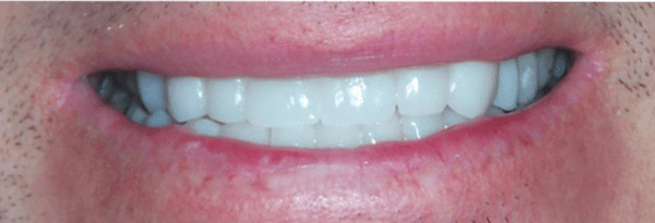 Invisalign Before & After